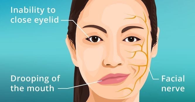 Bell's palsy